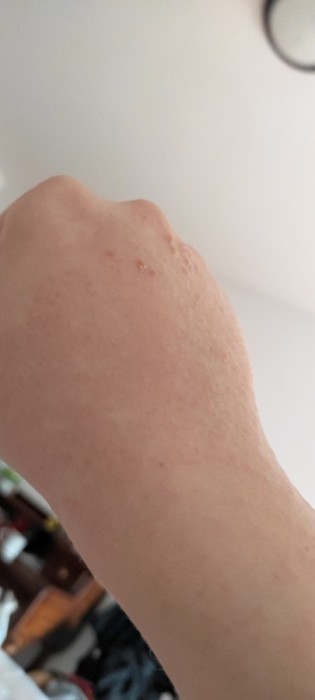 Skin irritation on hand
